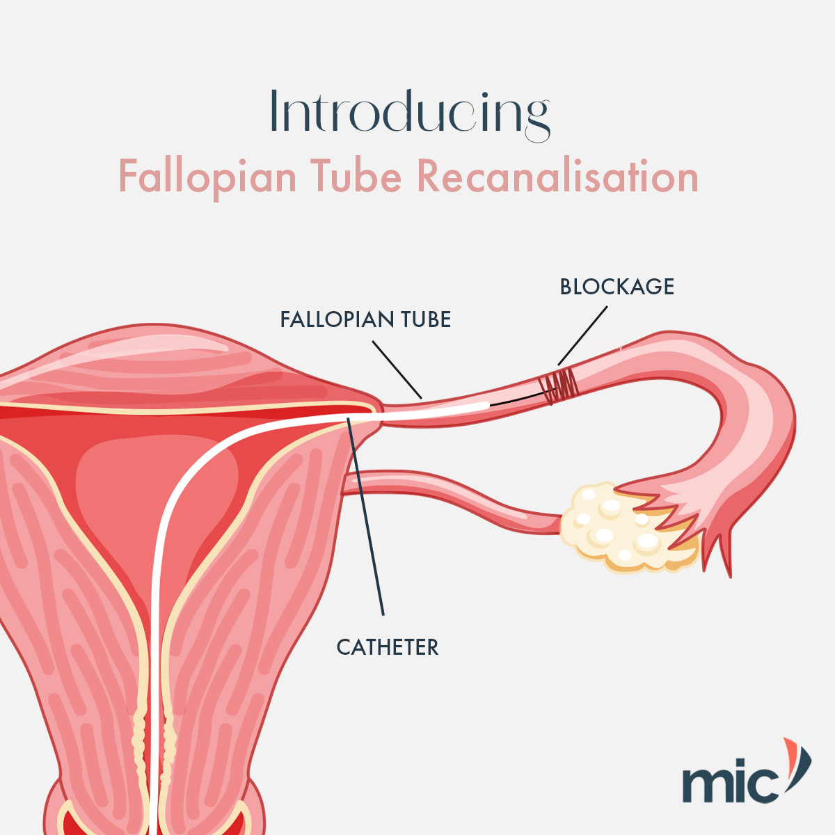 introducing-fallopian-tube-recanalisation-mic-radiology-group