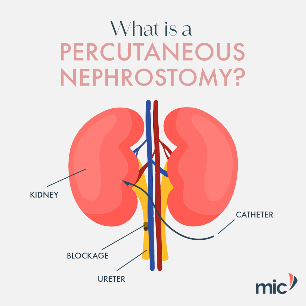 What is a Percutaneous nephrostomy? – MIC Radiology Group